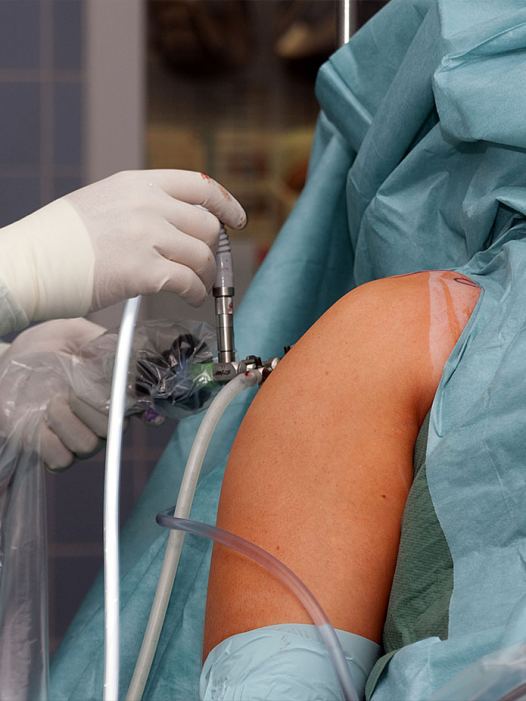 Arthroskopische Behandlung (Gelenkspiegelung)