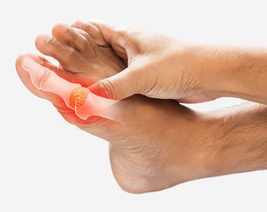 Wie entsteht ein Hallux rigidus?