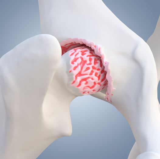 Behandlung der Hüftgelenksarthrose (Coxarthrose) in Düsseldorf