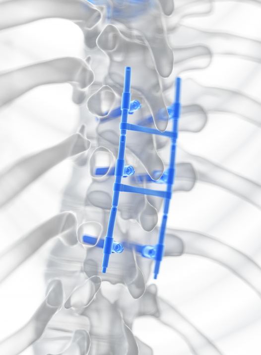 Behandlung einer Sprunggelenksarthrose durch Stabilisierung durch ein Titankäfig-Implantat in Düsseldorf