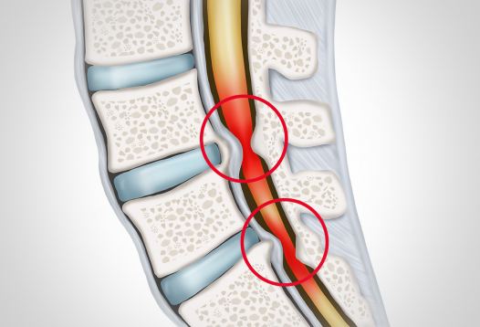 Spinalkanalstenose: Behandlung Einengungen des Wirbelkanals in Düsseldorf