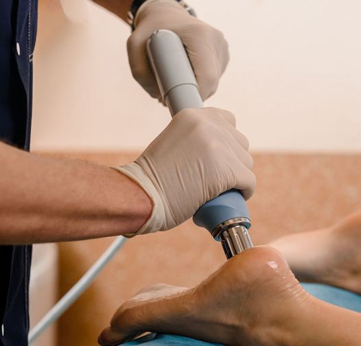 Behandlung des Fersensporns auf natürliche Weise mit Stoßwellentherapie in Düsseldorf