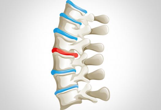 Linderung Ischiasbeschwerden orthopädischen Praxis in Düsseldorf