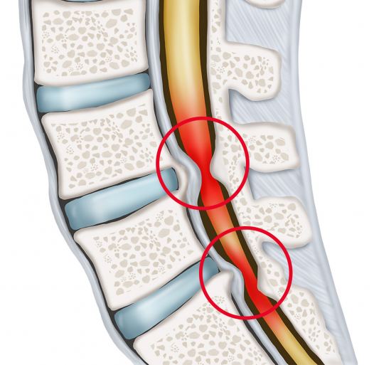 Symptome einer Spinalkanalstenose