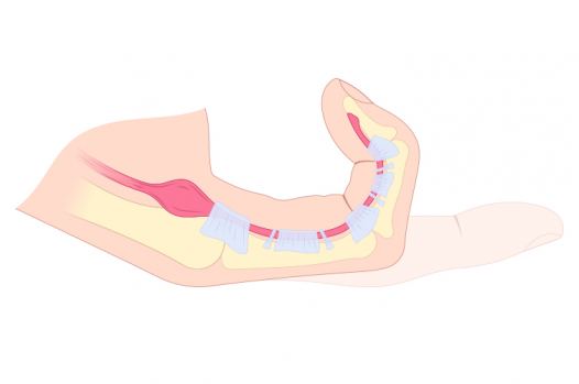 Ursachen für einen schnellenden Finger - orthopädischen Praxen in Düsseldorf